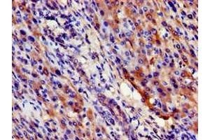 Immunohistochemistry of paraffin-embedded human liver cancer using ABIN7169599 at dilution of 1:100