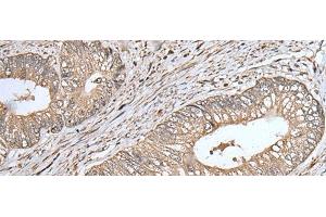 Immunohistochemistry of paraffin-embedded Human colorectal cancer tissue using UQCRQ Polyclonal Antibody at dilution of 1:45(x200) (UQCRQ antibody)