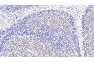 Detection of G6PD in Human Lymph node Tissue using Polyclonal Antibody to Glucose-6-phosphate Dehydrogenase (G6PD) (Glucose-6-Phosphate Dehydrogenase antibody)