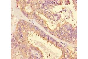 Immunohistochemistry of paraffin-embedded human endometrial cancer using ABIN7143136 at dilution of 1:100 (beta Actin antibody  (AA 102-375))