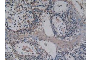 IHC-P analysis of Human Skin Cancer Tissue, with DAB staining. (NFkB antibody  (AA 805-892))