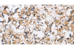 Immunohistochemistry of paraffin-embedded Human thyroid cancer using CKMT2 Polyclonal Antibody at dilution of 1:60 (CKMT2 antibody)