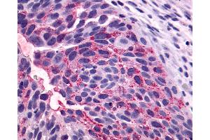 Anti-NTSR1 / NTR antibody IHC of human Bladder, Carcinoma.