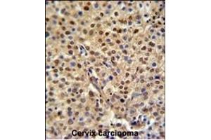 C19orf21 Antibody (N-term) (ABIN651044 and ABIN2840046) IHC analysis in formalin fixed and paraffin embedded human cervix carcinoma followed by peroxidase conjugation of the secondary antibody and DAB staining. (C19orf21 antibody  (N-Term))