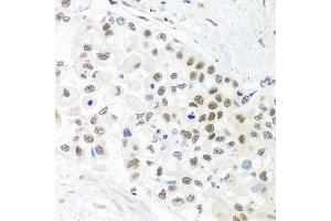 Immunohistochemistry of paraffin-embedded human lung cancer using TRMT1 antibody (ABIN5975089) at dilution of 1/100 (40x lens).