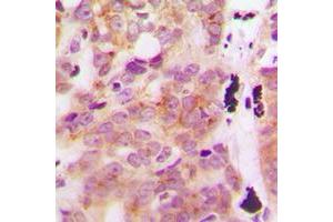 Immunohistochemical analysis of GLB1L3 staining in human breast cancer formalin fixed paraffin embedded tissue section. (GLB1L3 antibody  (Center))