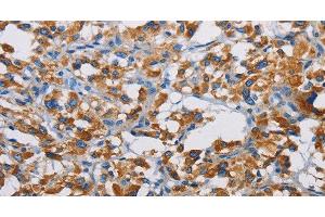 Immunohistochemistry of paraffin-embedded Human thyroid cancer tissue using TSPEAR Polyclonal Antibody at dilution 1:50 (TSPEAR antibody)