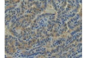 Detection of NRP1 in Human Thyroid cancer Tissue using Polyclonal Antibody to Neuropilin 1 (NRP1)