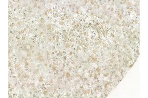ABIN6264887 and ABIN6276947 at 1/100 staining human astrocytoma by IHC-P. (RUVBL2 antibody  (Internal Region))