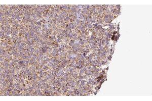 ABIN6273195 at 1/100 staining Human lymph cancer tissue by IHC-P. (SLC10A2 antibody  (C-Term))