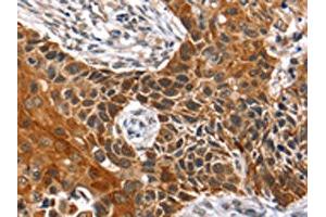 The image on the left is immunohistochemistry of paraffin-embedded Human esophagus cancer tissue using ABIN7129727(HOXB1 Antibody) at dilution 1/40, on the right is treated with fusion protein. (HOXB1 antibody)