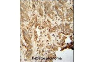 NAT14 antibody (N-term) (ABIN654245 and ABIN2844071) immunohistochemistry analysis in formalin fixed and paraffin embedded human hepatocarcinoma followed by peroxidase conjugation of the secondary antibody and DAB staining.