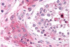 Human Testis (formalin-fixed, paraffin-embedded) stained with CACNB2 antibody ABIN214732 at 5 ug/ml followed by biotinylated goat anti-rabbit IgG secondary antibody ABIN481713, alkaline phosphatase-streptavidin and chromogen. (CACNB2 antibody  (N-Term))