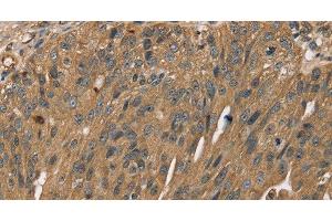 Immunohistochemistry of paraffin-embedded Human breast cancer using SCGB2A1 Polyclonal Antibody at dilution of 1:50