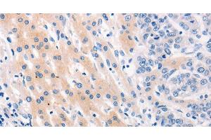 Immunohistochemistry of paraffin-embedded Human lung cancer tissue using MUC2 Polyclonal Antibody at dilution 1:60 (MUC2 antibody)