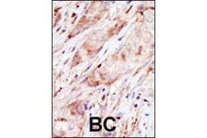 Formalin-fixed and paraffin-embedded human cancer tissue reacted with the primary antibody, which was peroxidase-conjugated to the secondary antibody, followed by AEC staining. (GCK antibody  (C-Term))