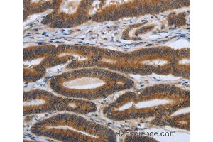 Immunohistochemistry of Human ovarian cancer using PDGFA Polyclonal Antibody at dilution of 1:70
