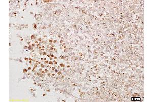 Formalin-fixed and paraffin embedded mouse tumor tissue labeled with Anti-PAX1 Polyclonal Antibody, Unconjugated (ABIN673269) at 1:200 followed by conjugation to the secondary antibody and DAB staining. (PAX1 antibody  (AA 151-250))