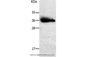 Western blot analysis of Human liver cancer tissue, using PPAP2A Polyclonal Antibody at dilution of 1:650 (PLPP1 antibody)