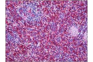 Immunohistochemistry (Paraffin-embedded Sections) (IHC (p)) image for anti-Matrix Metallopeptidase 11 (Stromelysin 3) (MMP11) (Internal Region) antibody (ABIN784216)