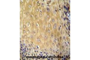 C6orf70 antibody (Center) immunohistochemistry analysis in formalin fixed and paraffin embedded human esophageal carcinoma followed by peroxidase conjugation of the secondary antibody and DAB staining. (C6orf70 antibody  (Middle Region))