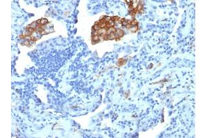 Formalin-fixed, paraffin-embedded human Lung Carcinoma stained with CD209 Mouse Monoclonal Antibody (C209/1781). (DC-SIGN/CD209 antibody)