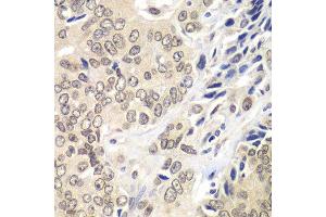 Immunohistochemistry of paraffin-embedded human prostate cancer using RNF2 antibody. (RNF2 antibody  (AA 1-336))