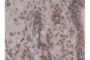 Detection of ENPP2 in Human Stomach cancer Tissue using Monoclonal Antibody to Ectonucleotide Pyrophosphatase/Phosphodiesterase 2 (ENPP2) (ENPP2 antibody  (AA 637-905))