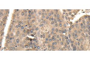 Immunohistochemistry of paraffin-embedded Human liver cancer using TXN Polyclonal Antibody at dilution of 1:40 (TXN antibody)