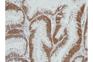 IHC-P Image Immunohistochemical analysis of paraffin-embedded human gastric cancer, using AKR1C4, antibody at 1:100 dilution. (AKR1C4 antibody)