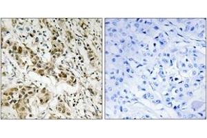 Immunohistochemistry analysis of paraffin-embedded human breast carcinoma tissue, using CtBP1 (Ab-422) Antibody.