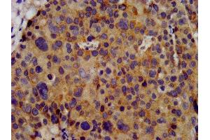 IHC image of ABIN7163969 diluted at 1:300 and staining in paraffin-embedded human pancreatic cancer performed on a Leica BondTM system. (KCNC3 antibody  (AA 638-745))