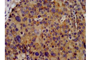 IHC image of ABIN7163969 diluted at 1:300 and staining in paraffin-embedded human pancreatic cancer performed on a Leica BondTM system.