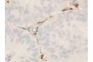 Immunohistochemical staining of ROCK2 on formalin fixed, paraffin embedded human intestinal cancer with ROCK2 polyclonal antibody . (ROCK2 antibody  (N-Term))
