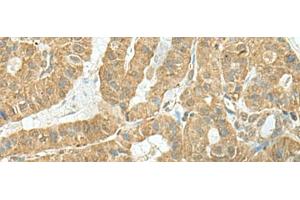 Immunohistochemistry of paraffin-embedded Human thyroid cancer tissue using TENT5C Polyclonal Antibody at dilution of 1:110(x200)