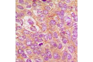 Immunohistochemical analysis of IKK beta (pY188) staining in human breast cancer formalin fixed paraffin embedded tissue section.
