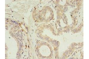 Immunohistochemistry of paraffin-embedded human breast cancer using ABIN7167192 at dilution of 1:100 (RERG antibody  (AA 1-199))