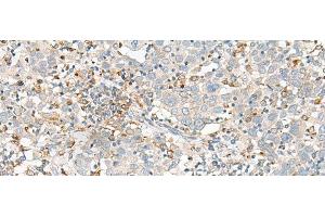 Immunohistochemistry of paraffin-embedded Human cervical cancer tissue using SLC41A3 Polyclonal Antibody at dilution of 1:35(x200) (SLC41A3 antibody)