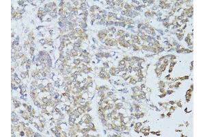 Immunohistochemistry of paraffin-embedded human colon carcinoma using TEFM antibody (ABIN5974873) at dilution of 1/100 (40x lens). (TEFM antibody)
