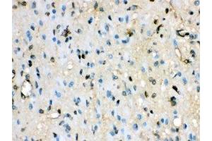 IHC-P: VCP antibody testing of human glioma tissue (VCP antibody  (AA 732-760))