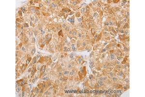 Immunohistochemistry of Human liver cancer using NGF Polyclonal Antibody at dilution of 1:40 (Nerve Growth Factor antibody)