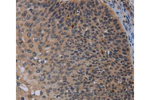 Immunohistochemistry of Human cervical cancer using P2RX2 Polyclonal Antibody at dilution of 1:50