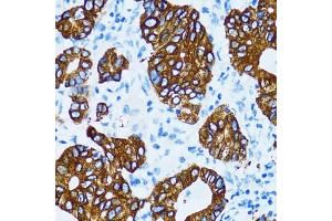 Immunohistochemistry of paraffin-embedded human gastric cancer using CTSE antibody. (Cathepsin E antibody)