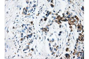 Immunohistochemical staining of paraffin-embedded Adenocarcinoma of breast tissue using anti-ATP5B mouse monoclonal antibody. (ATP5B antibody)