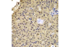 Immunohistochemistry of paraffin-embedded human well-differentiated squamous skin carcinoma using CCNA2 antibody (ABIN5995369) at dilution of 1/100 (40x lens). (Cyclin A antibody)
