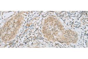 Immunohistochemistry of paraffin-embedded Human esophagus cancer tissue using HELT Polyclonal Antibody at dilution of 1:40(x200) (HELT antibody)