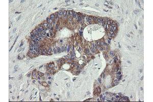 Immunohistochemical staining of paraffin-embedded Adenocarcinoma of Human colon tissue using anti-VBP1 mouse monoclonal antibody. (VBP1 antibody)