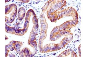IHC image of ABIN7154558 diluted at 1:400 and staining in paraffin-embedded human endometrial cancer performed on a Leica BondTM system. (GDF9 antibody  (AA 320-454))