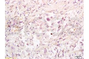 Formalin-fixed and paraffin embedded human lung carcinoma tissue labeled with Anti-RRM1 Polyclonal Antibody, Unconjugated (ABIN731543) at 1:200 followed by conjugation to the secondary antibody, (SP-0023), and DAB staining