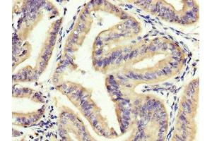 IHC image of ABIN7151810 diluted at 1:400 and staining in paraffin-embedded human endometrial cancer performed on a Leica BondTM system. (EOMES antibody  (AA 562-676))